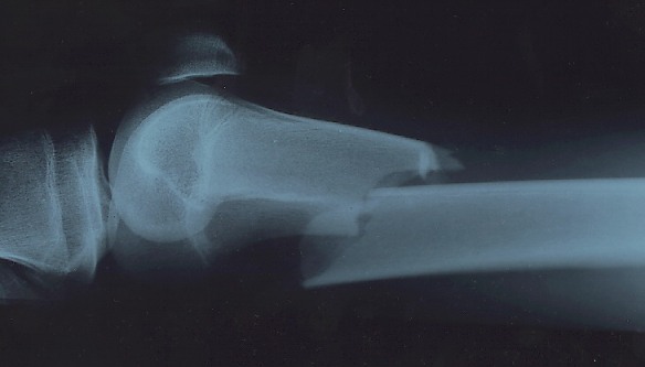 x-ray broken leg